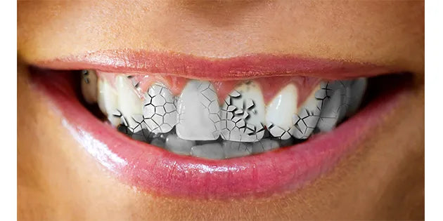 GlowUp : 5 Erreurs à Éviter Lors du Blanchiment Dentaire Maison